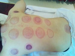 拔罐-睿明真达专业皮肤护理中心