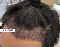 -大麦微针植发全国连锁