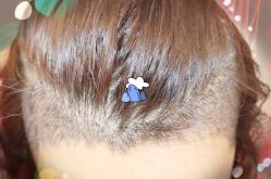 -大麦微针植发全国连锁