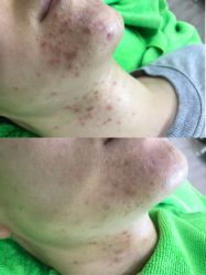 -清颜堂专业祛痘