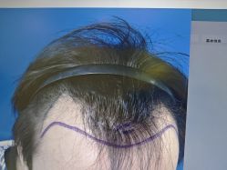 -碧莲盛·不剃发植发