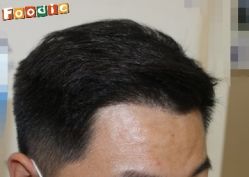 -大麦微针植发丨全国连锁