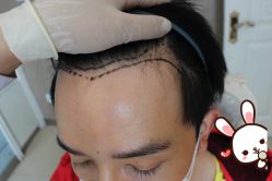 -大麦微针植发丨全国连锁