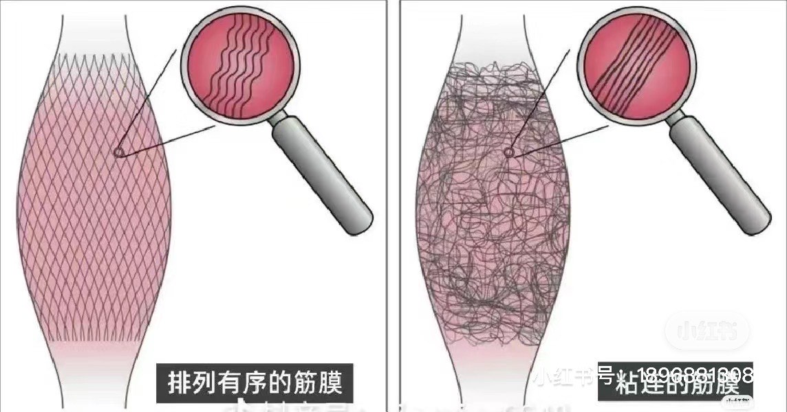 肩颈乳酸堆积图片