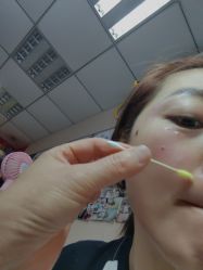 -北京美痣堂古方祛痣斑疣瘊