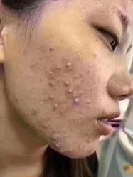 -瑶芳清颜草本祛痘