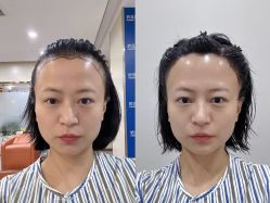 -碧莲盛·不剃发植发