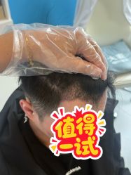 -大麦微针植发全国连锁