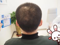 -大麦微针植发丨全国连锁