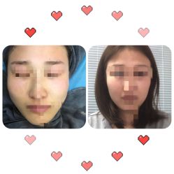 体验后-More摩尔医美の注射线雕光电中心