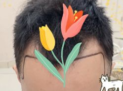 -大麦微针植发全国连锁