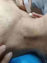 -瑶芳清颜草本祛痘