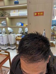 体验后-大麦微针植发丨全国连锁