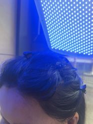 -碧莲盛·不剃发植发