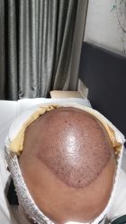 -碧莲盛·不剃发植发