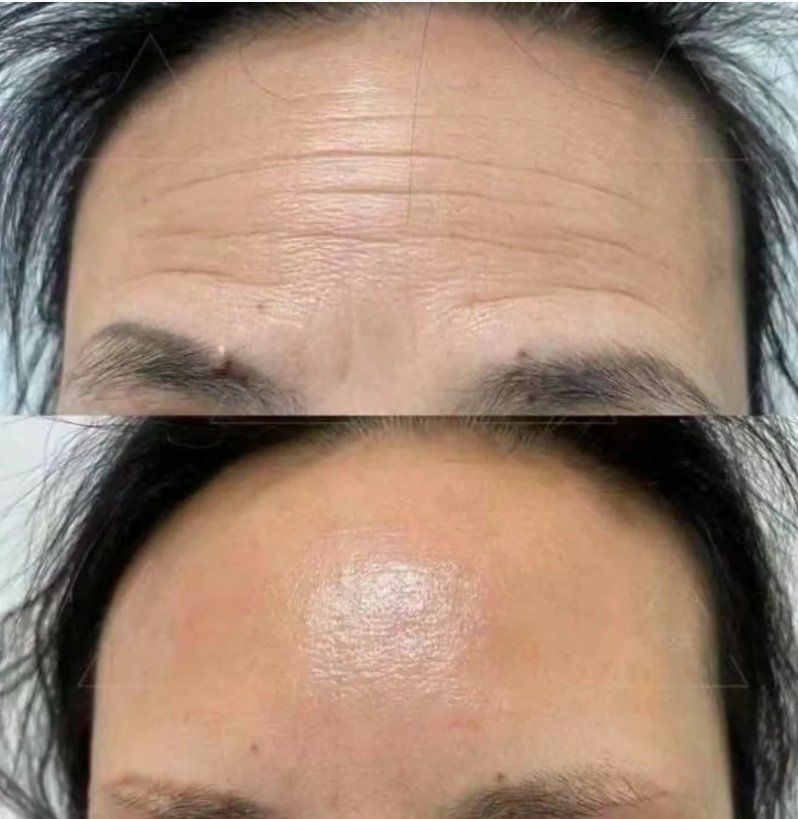 【抬头纹除皱】术后15天效果分享