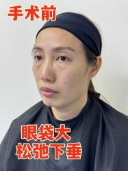 -广州健丽·去眼袋医疗美容机构