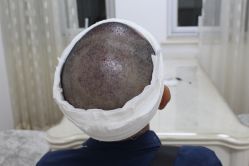 -大麦微针植发丨全国连锁