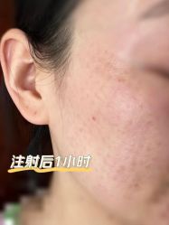 体验后-东剑医学美容·注射美学中心