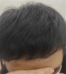 -大麦微针植发丨全国连锁