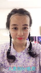 点击看大图 -大麦微针植发丨全国连锁