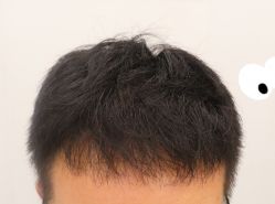 -大麦微针植发全国连锁