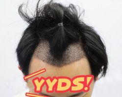 -大麦微针植发丨全国连锁