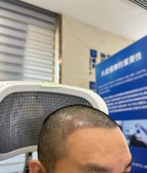 点击看大图 -大麦微针植发全国连锁