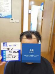 -大麦微针植发全国连锁