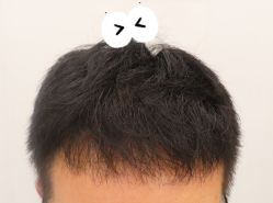 -大麦微针植发全国连锁