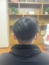 体验后-大麦微针植发全国连锁