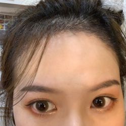 -碧莲盛·不剃发植发