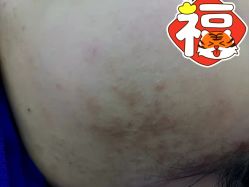 -蕾特恩专业祛痘国际连锁