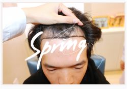 体验后-大麦微针植发全国连锁