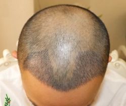 -大麦微针植发丨全国连锁