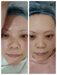 体验前-郡艺医疗美容·微整·眼鼻吸脂