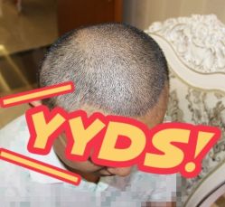 -大麦微针植发丨全国连锁