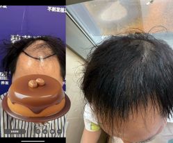 -碧莲盛·不剃发植发