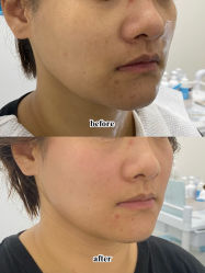 -agge蛋白医美