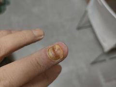 -世龙世家甲沟炎·灰指甲·嵌甲矫正·修脚(武侯区双楠店)