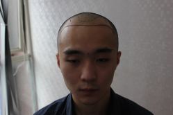 点击看大图 -大麦微针植发丨全国连锁