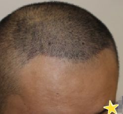 -大麦微针植发丨全国连锁