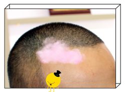 -大麦微针植发全国连锁