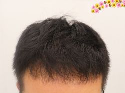 -大麦微针植发全国连锁
