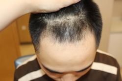 -大麦微针植发丨全国连锁