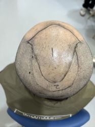 -大麦微针植发全国连锁