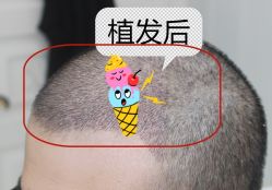 -大麦微针植发全国连锁