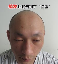 -碧莲盛·不剃发植发