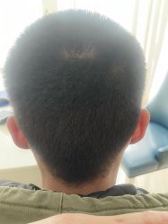 -大麦微针植发丨全国连锁