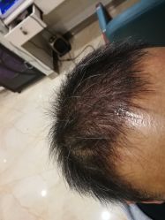 -碧莲盛·不剃发植发